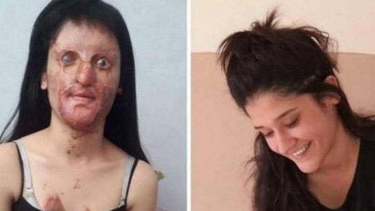 Yüzüne asit döken erkek arkadaşını affeden Berfin özür diledi: Yanlış ve sağlıksız bir karardı