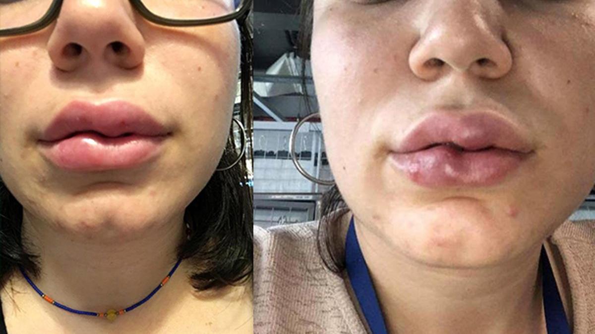 Dudak dolgusuna ihmal iddiasında doktorun ifadesi ortaya çıktı