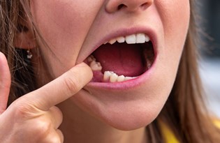 Corona virüs ani ve acısız diş kaybına neden olabilir