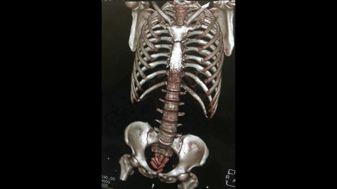 Beş İranlı'nın midesinden 292 kapsül uyuşturucu çıktı