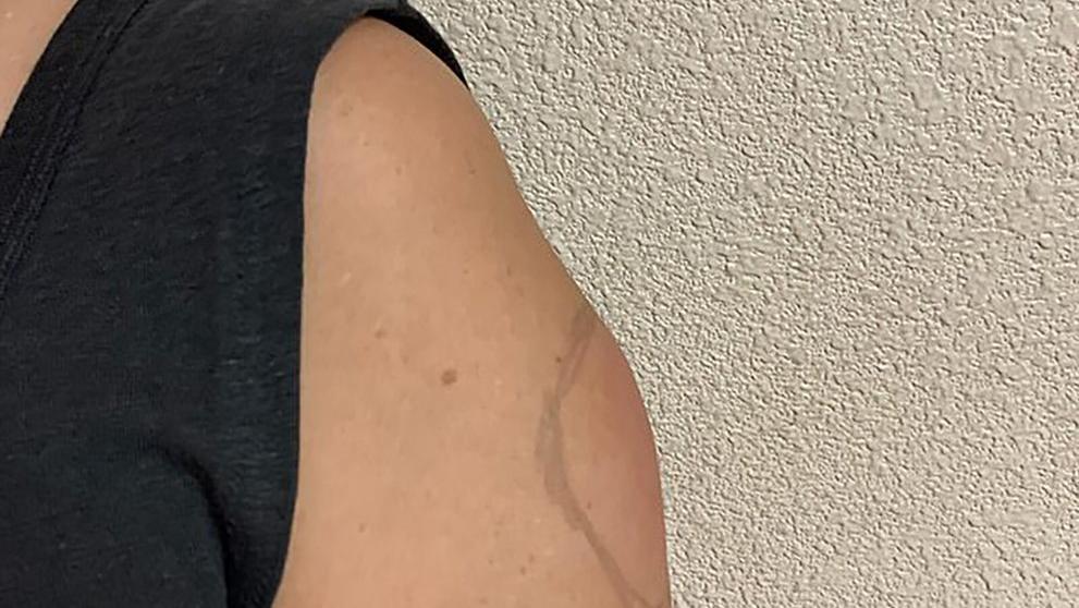 Moderna'nın corona aşısında bir yan etki daha