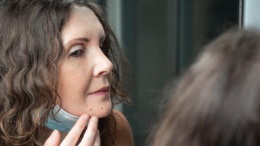 Maskede alerjik reaksiyona dikkat!