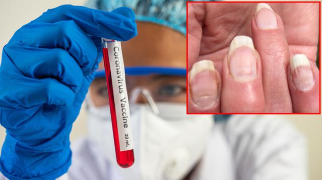 Koronavirüste yeni bir belirti daha! Enfeksiyon sonrası tırnaklarda iz bırakıyor