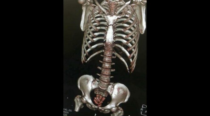 Beş İranlı’nın midesinden 292 kapsül uyuşturucu çıktı