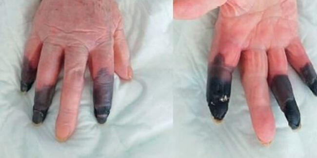 Koronavirüs hastası kadın kangren oldu, 3 parmağı kesildi