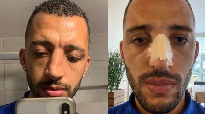 Trabzonsporlu Vitor Hugo paylaştı! ‘Dün burnum kırıldı bugün yerine koyduk’