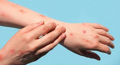 Maymun Çiçeği salgını Japonya'ya sıçradı