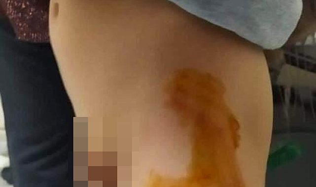 Mardin'de sokak köpeği 6 yaşındaki çocuğu ısırdı