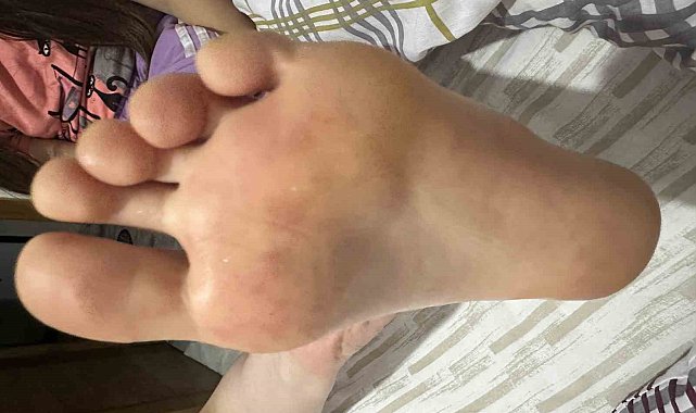 Çocuklarda artan el ayak ağız hastalığına dikkat: Uzmanlar tatilde ortak kullanılan alanlara karşı uyardı